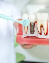 China - Dental Implants Market by End-user, Material and Product - Forecast and Analysis 2023-2027