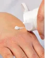 Eczema Therapeutics Market by Indication and Geography - Forecast and Analysis 2022-2026