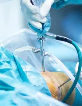 Arthroscopy Devices Market by Product and Geography - Forecast and Analysis 2021-2025