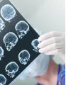 Cranial Implants Market by Product, End-user, and Geography - Forecast and Analysis 2021-2025
