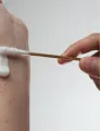 Pruritus Therapeutic Market by Disease Type and Geography - Forecast and Analysis 2021-2025