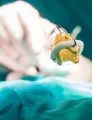 Prosthetic Heart Valves Market by Product and Geography - Forecast and Analysis 2022-2026