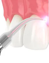 Dental Lasers Market by Product, End-user, and Geography - Forecast and Analysis 2021-2025