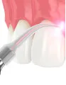 Dental Lasers Market by Product, End-user, and Geography - Forecast and Analysis 2021-2025