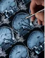 Epilepsy Therapeutics Market in APAC by Product and Geography - Forecast and Analysis 2021-2025
