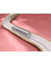 Peripheral Vascular Stents Market by Product, End-user, and Geography - Forecast and Analysis 2020-2024