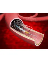 Mechanical Thrombectomy Devices Market by End-user and Geography - Forecast and Analysis 2020-2024