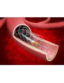 Mechanical Thrombectomy Devices Market by End-user and Geography - Forecast and Analysis 2020-2024