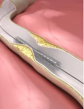 Embolic Protection Devices Market by Product and Geography - Forecast and Analysis 2021-2025