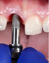 Metal Implants and Medical Alloys Market - North America, Europe, EMEA, APAC : US, Canada, China, Germany, UK - Forecast 2023-2027