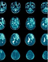 Glioblastoma Multiforme Treatment Market by End-user and Geography - Forecast and Analysis 2022-2026