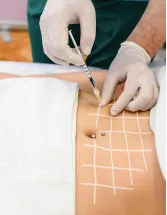 Liposuction Devices Market by End-user and Geography - Forecast and Analysis 2021-2025