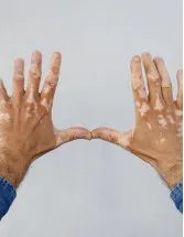 Vitiligo Therapeutics Market by Route of Administration and Geography - Forecast and Analysis 2022-2026