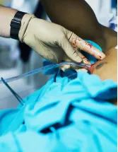 Surgical Drains/Wound Drainage Market by Type and Geography - Forecast and Analysis 2022-2026