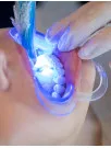Dental Curing Lights Market by Product Type, End-user, and Geography - Forecast and Analysis 2023-2027