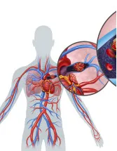 Pulmonary Embolism Therapeutics Market by Application, Route Of Administration, and Geography- Forecast and analysis of 2023-2027