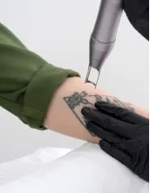 Tattoo Removal Market By End-user, Type and Geography - Forecast And Analysis 2023-2027