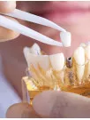 Dental Implants Market by End-user, Material, and Geography - Forecast and Analysis 2023-2027